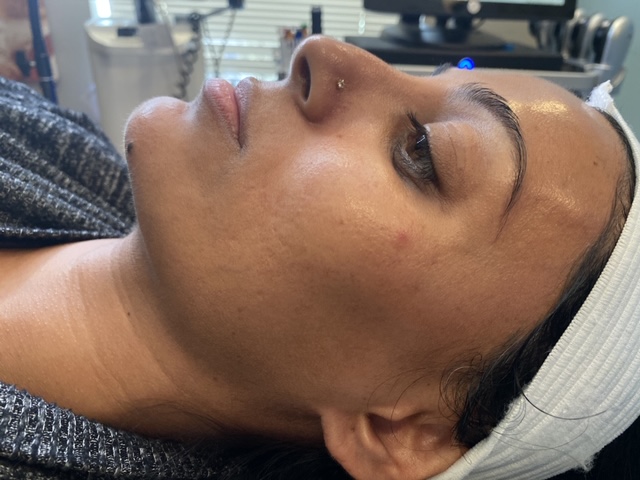 Before and after a chemical peel.