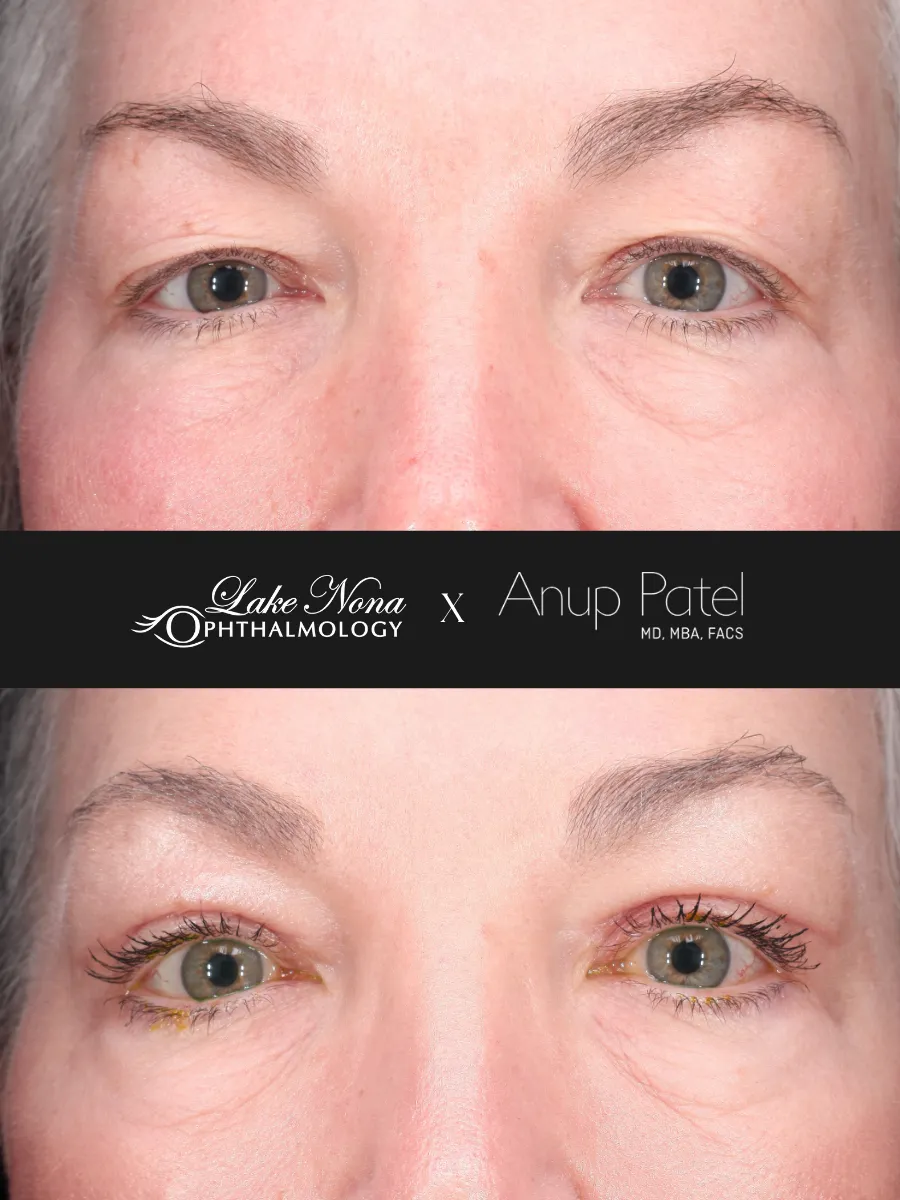 Before/After Brow Images